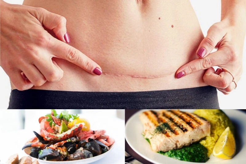 Kinh nghiệm ở cữ sau sinh mổ