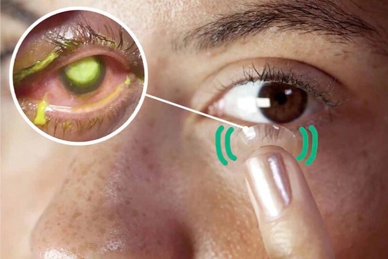 mẹo chữa đau mắt đỏ nhanh nhất