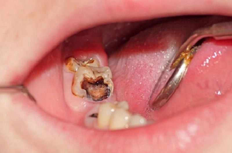 mẹo chữa đau răng sâu