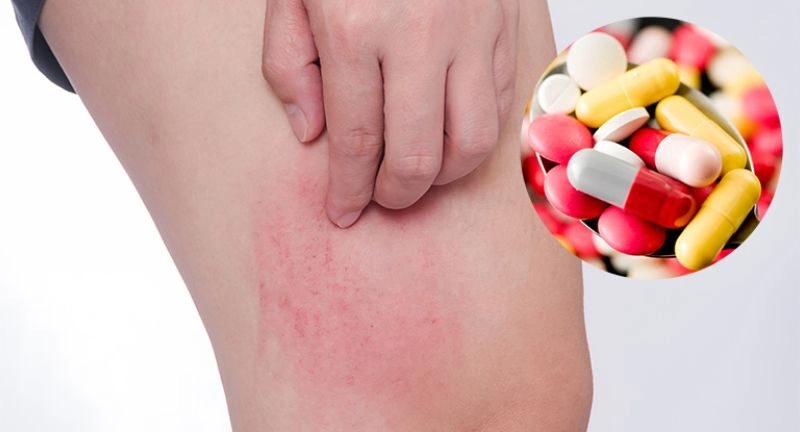 mẹo chữa mề đay