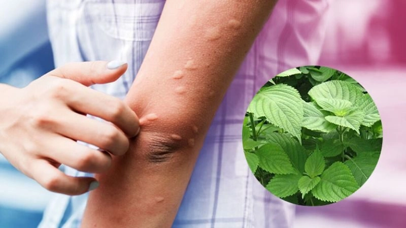 mẹo chữa mề đay
