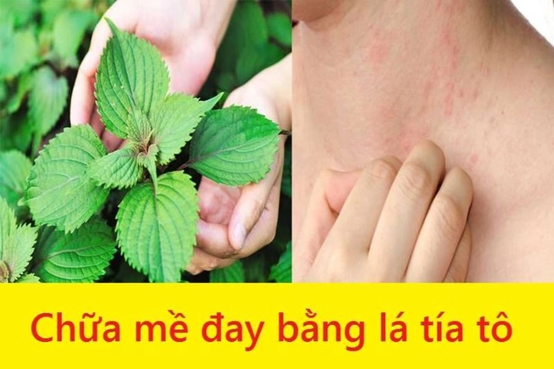 mẹo chữa mề đay