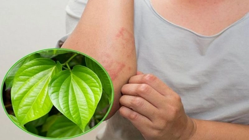 mẹo chữa mề đay