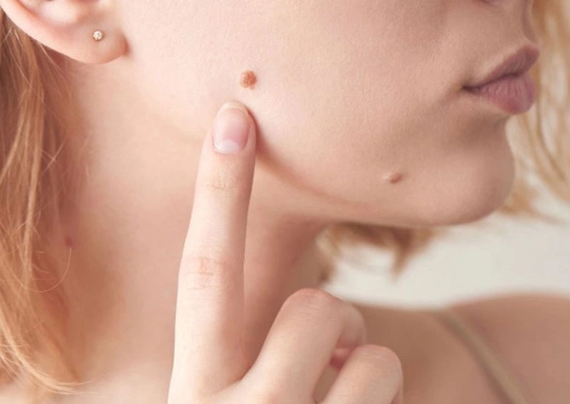 mẹo chữa mụn cóc dân gian