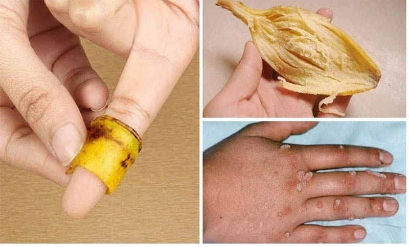 mẹo chữa mụn cóc dân gian