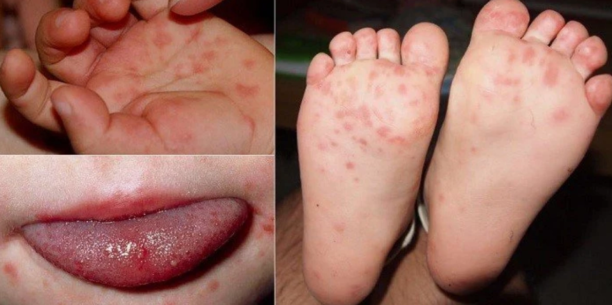 mẹo dân gian chữa bệnh chân tay miệng