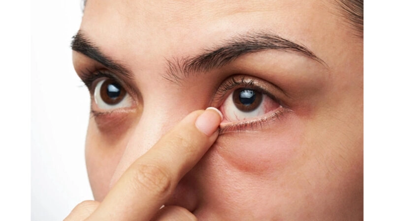 Mẹo dân gian chữa bụi bay vào mắt