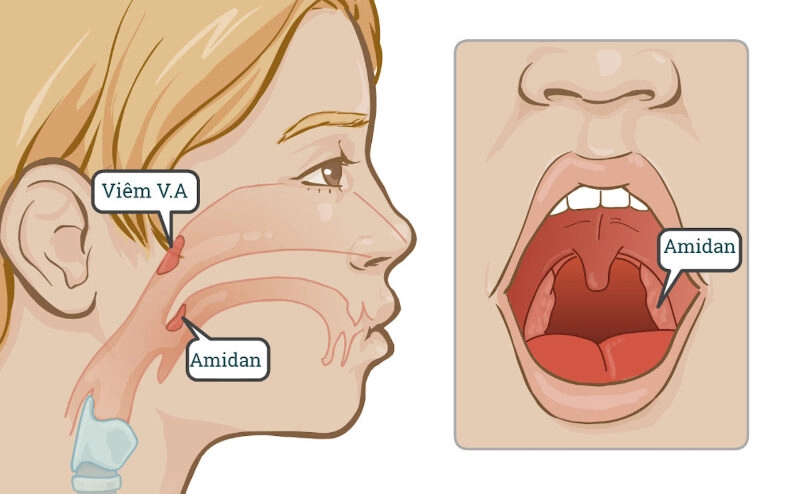 Mẹo dân gian chữa khò khè cho trẻ sơ sinh