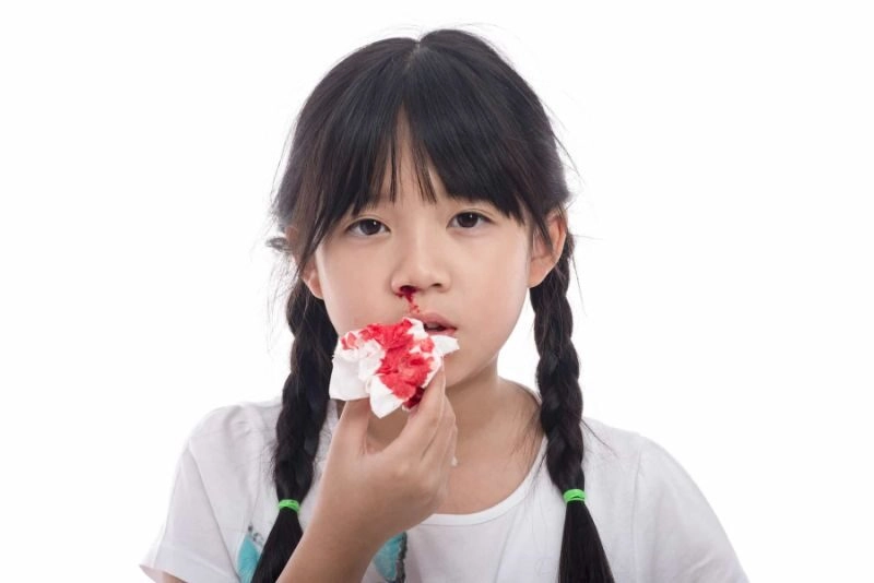 mẹo vặt chữa chảy máu cam