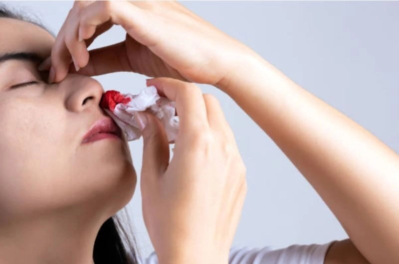 mẹo vặt chữa chảy máu cam